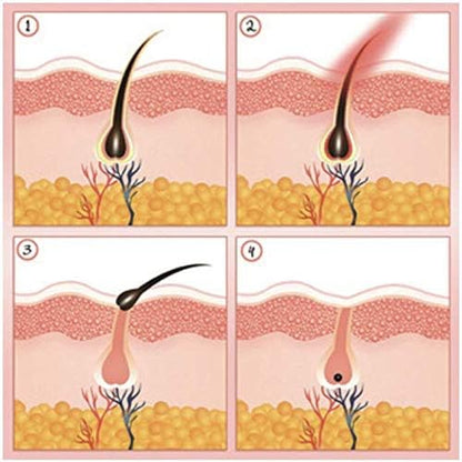 LESCOLTON IPL T006 - Laser Epilator for Long-Lasting Hair Removal - Skin Colour Sensor - 5 Power Levels - 300,000 Pulses - Home Use - Painless - SmartGatelb