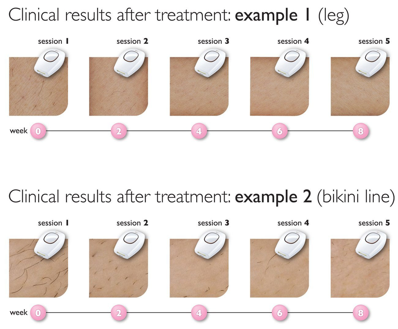 Philips Lumea Essential Hair Removal - SmartGatelb